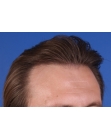 After Hair Transplant&nbsp;2 Sessions (Areas)